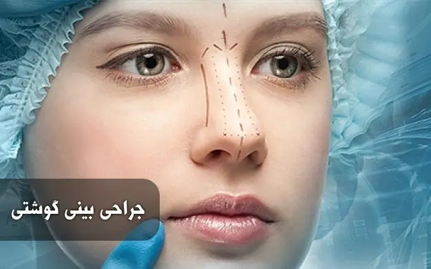 عمل بینی گوشتی در رشت