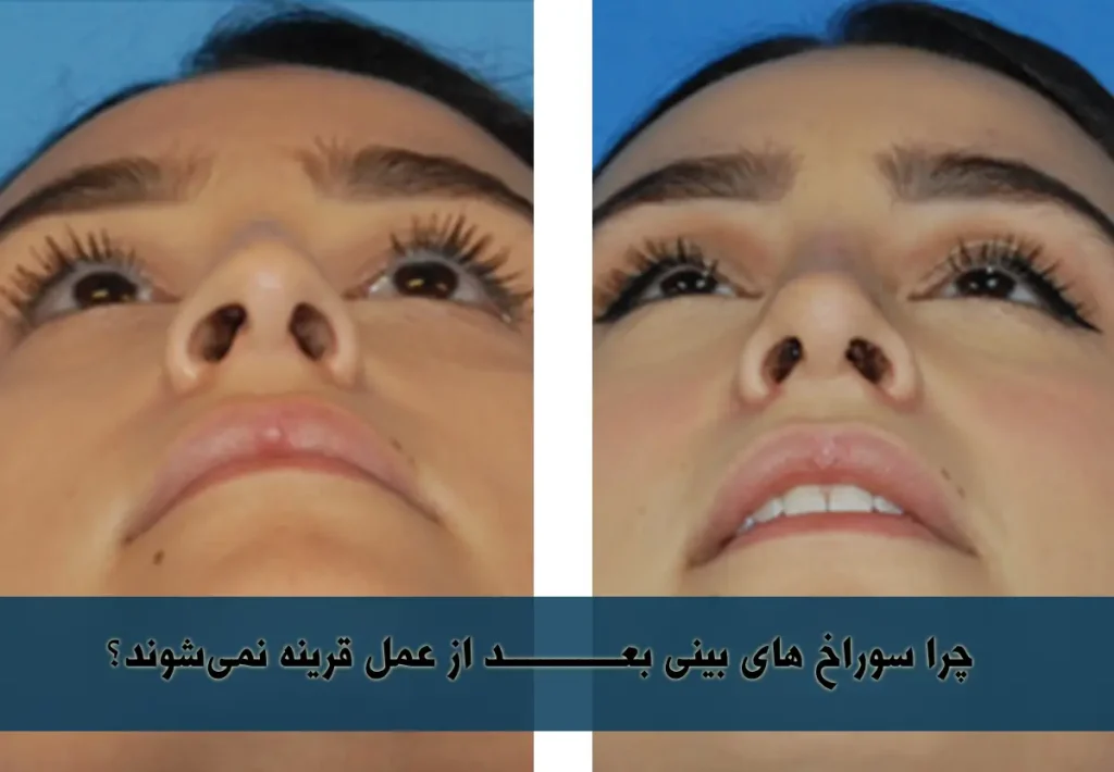 غیرقرینگی سوراخ های بینی بعد از عمل