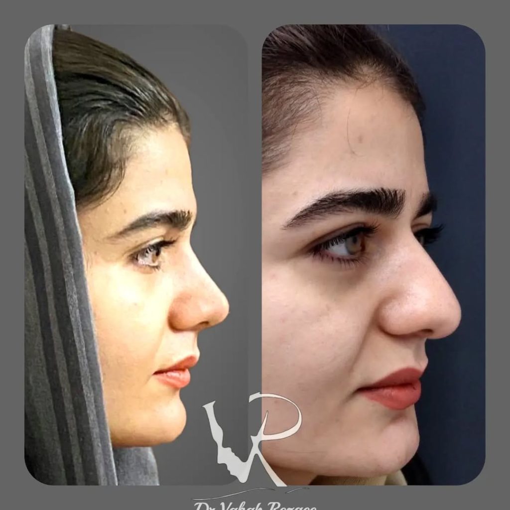 نمونه کار جراحی بینی طبیعی در رشت