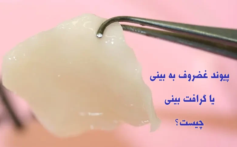 پیوند غضروف به بینی در جراحی بینی