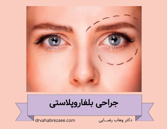عمل افتادگی پلک در رشت؛ بلفاروپلاستی در رشت