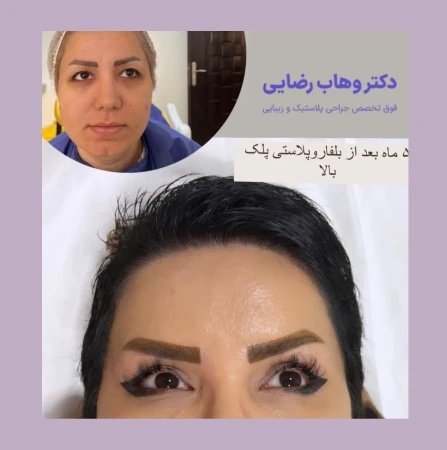 نمونه کار بلفاروپلاستی - دکتر وهاب رضایی