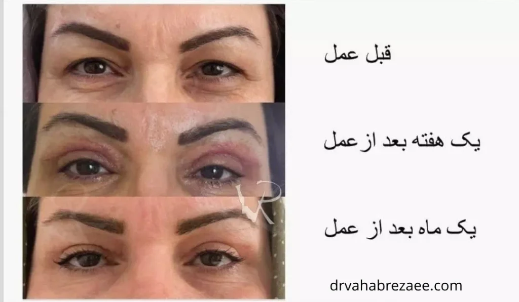 نمونه کار بلفاروپلاستی - عکس قبل و بعد از بلفاروپلاستی