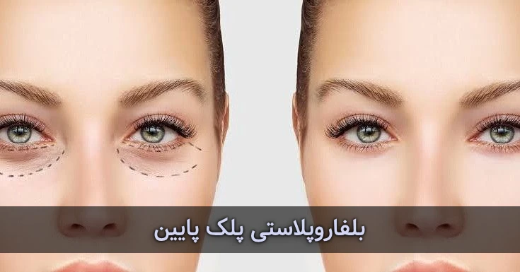بلفاروپلاستی پلک پایین در رشت