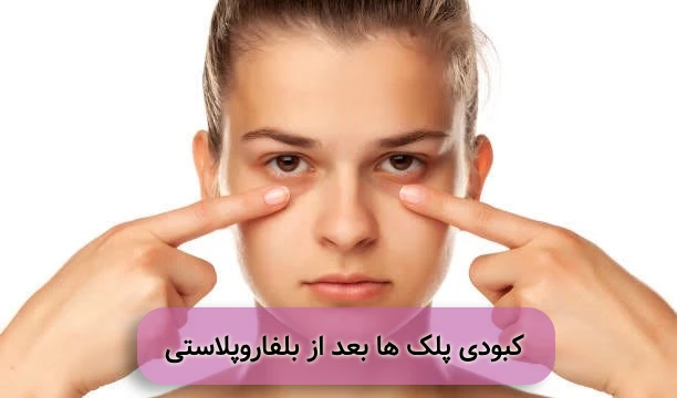 علت و نحوه درمان کبودی اطراف چشم بعد از بلفاروپلاستی