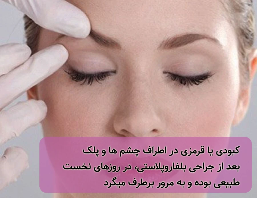 کبودی بعد از بلفاروپلاستی