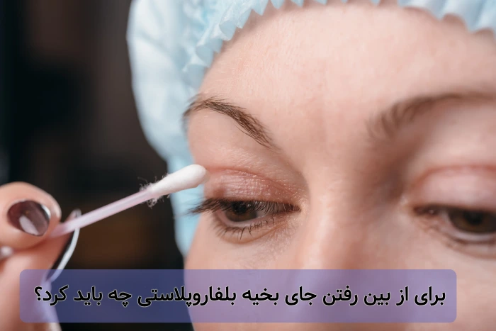 از بین بردن جای بخیه بلفاروپلاستی