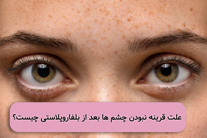 عدم تقارن چشم ها بعد از بلفاروپلاستی